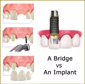 Benefits of Dental Implants