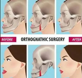 Corrective Jaw Surgery