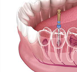 Root Canal Treatment in Bangalore