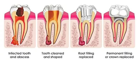 Root Canal Treatment