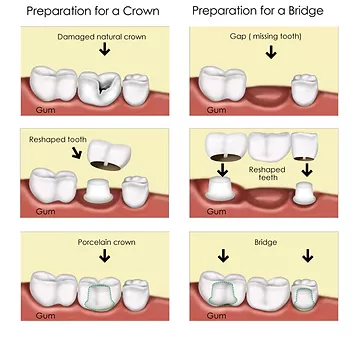 Periodontal (gums) treatment