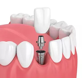 Dental Implants in Bangalore