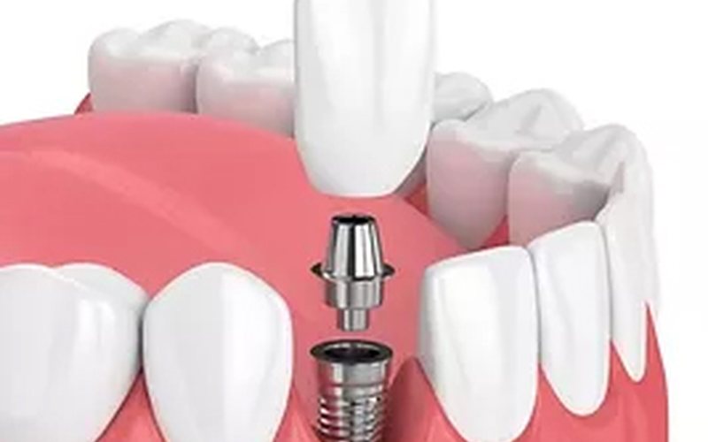Dental implant placed in the lower jaw