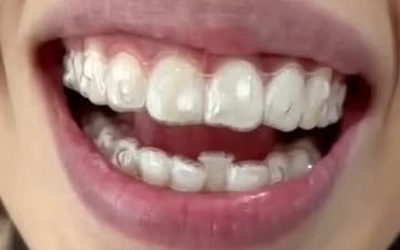 Clear invisible aligner tray fitted over teeth