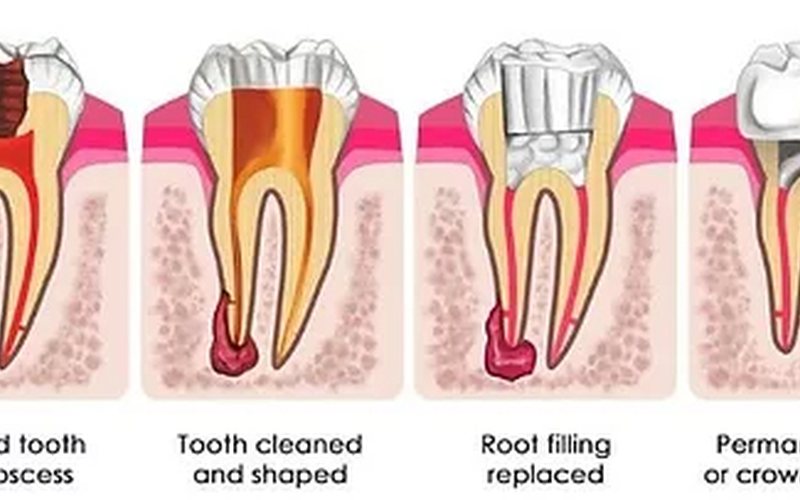 Stages of root canal treatment illustrated