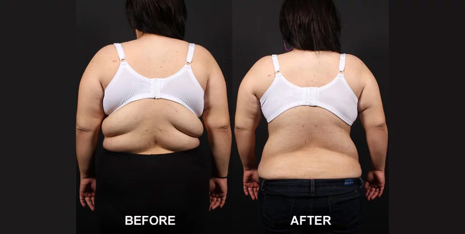 Bra Fat Reduction in malleswaram