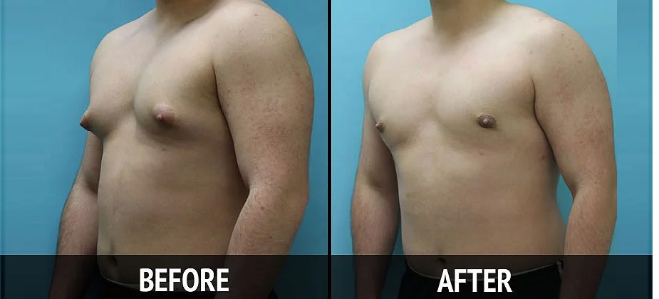 Gynecomastia in malleswaram